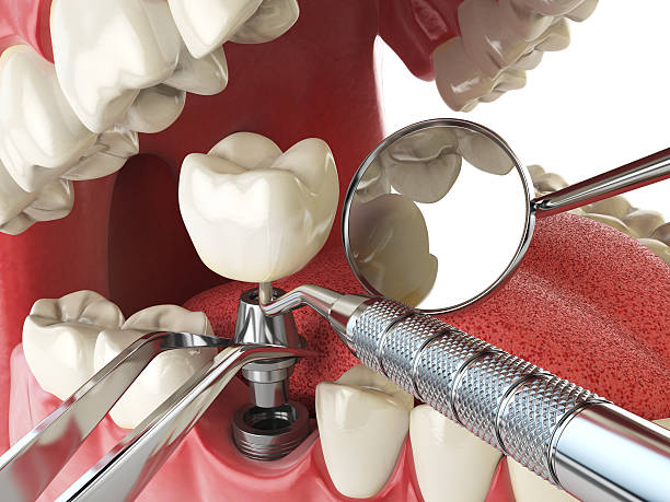 Best Emergency Dentist for Knocked-Out Tooth in Pampa, TX